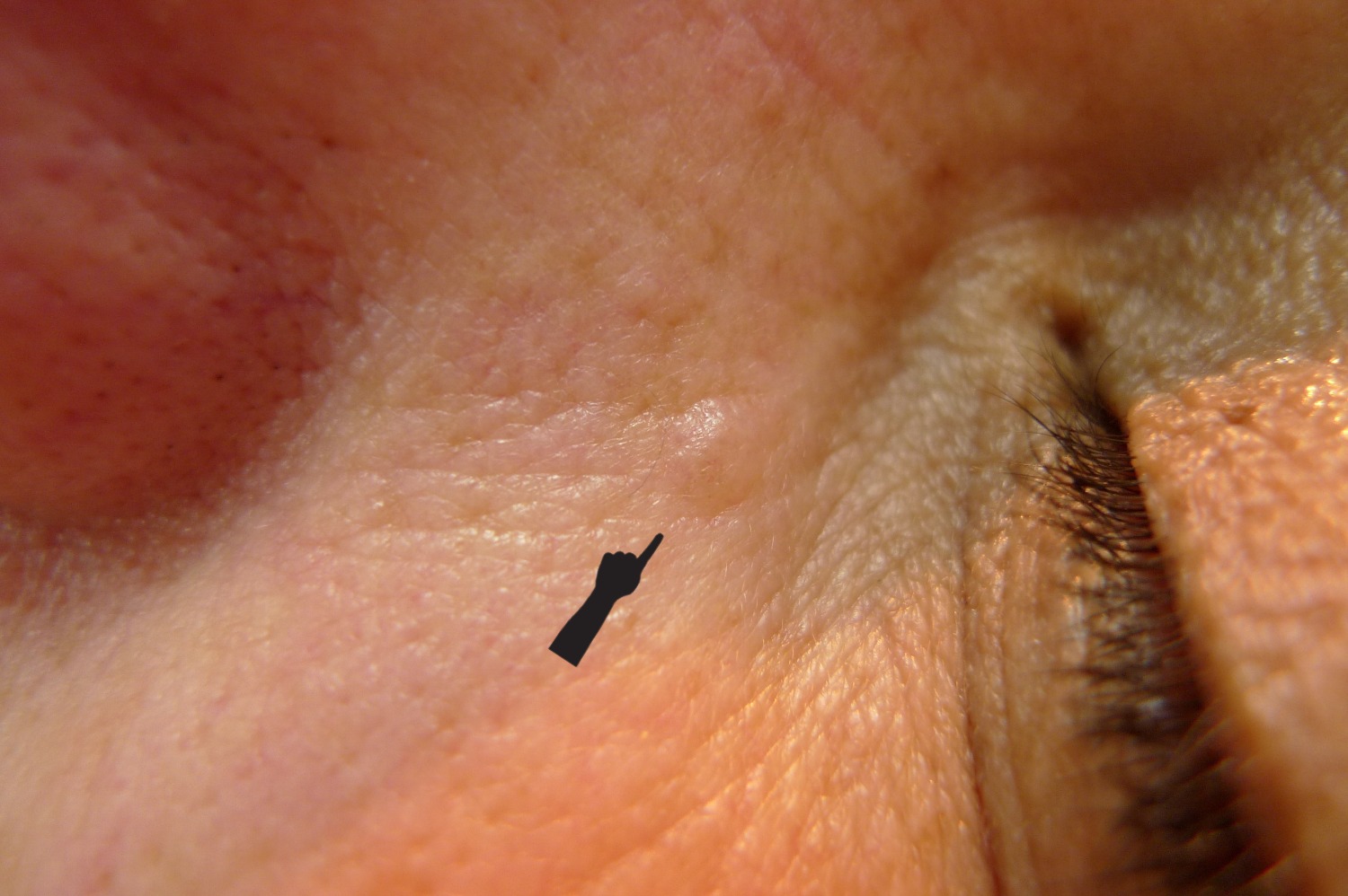 Carcinoma basocelular