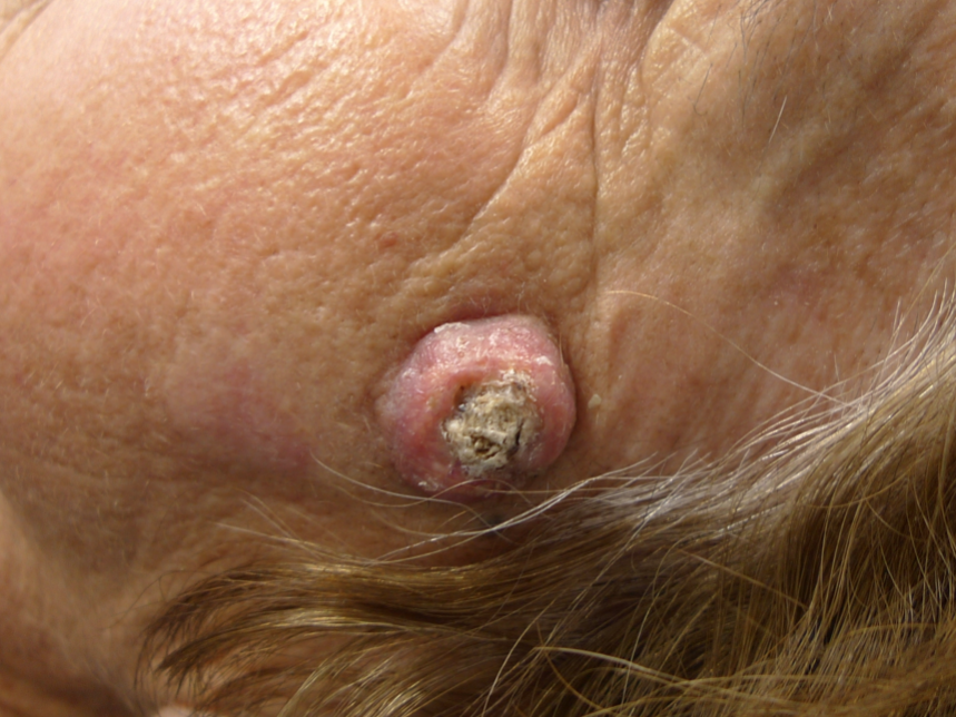Carcinoma espinocelular