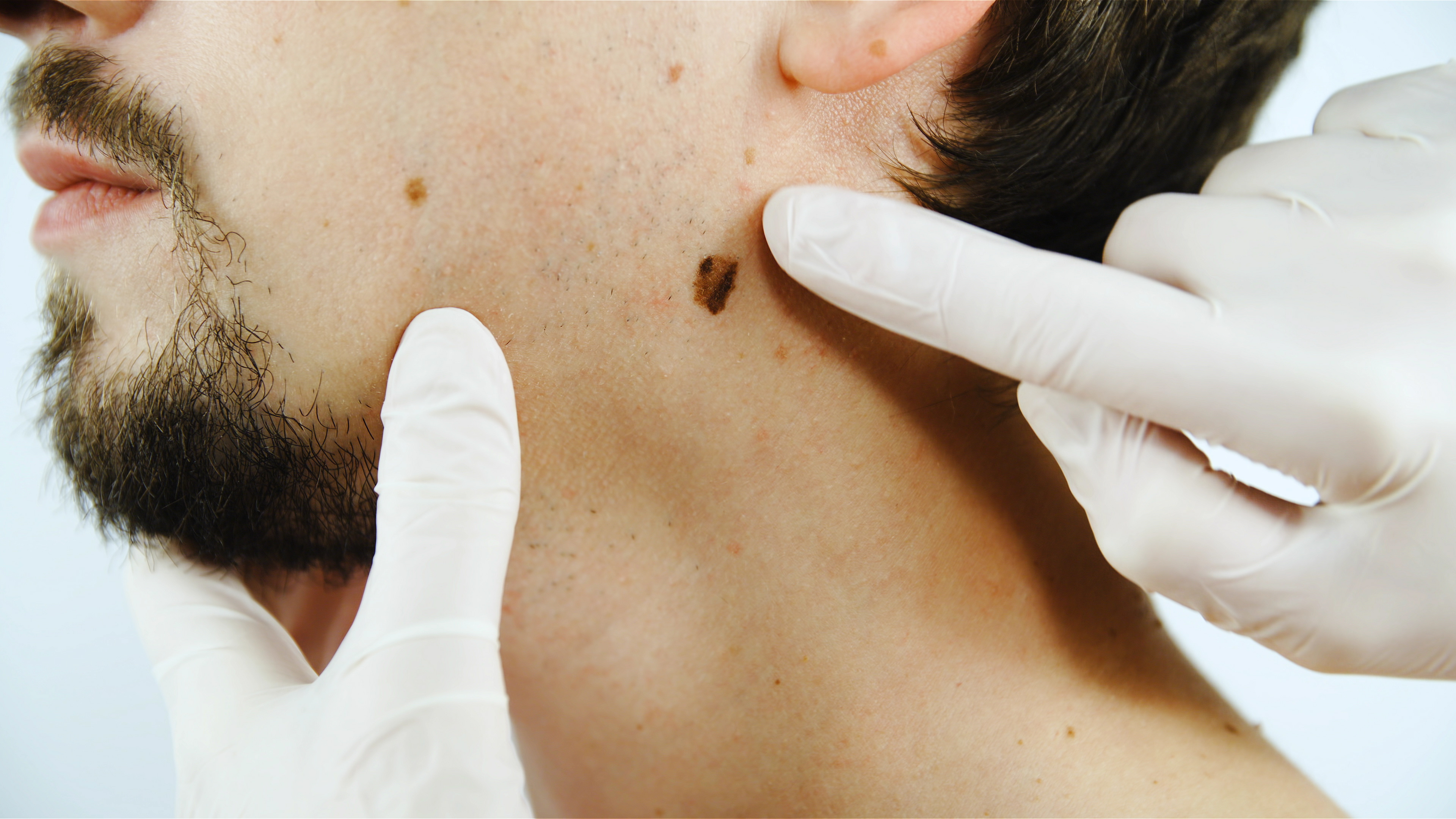 Evaluación de melanoma